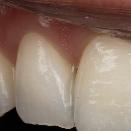 Anterior e.max crowns, close-up macro