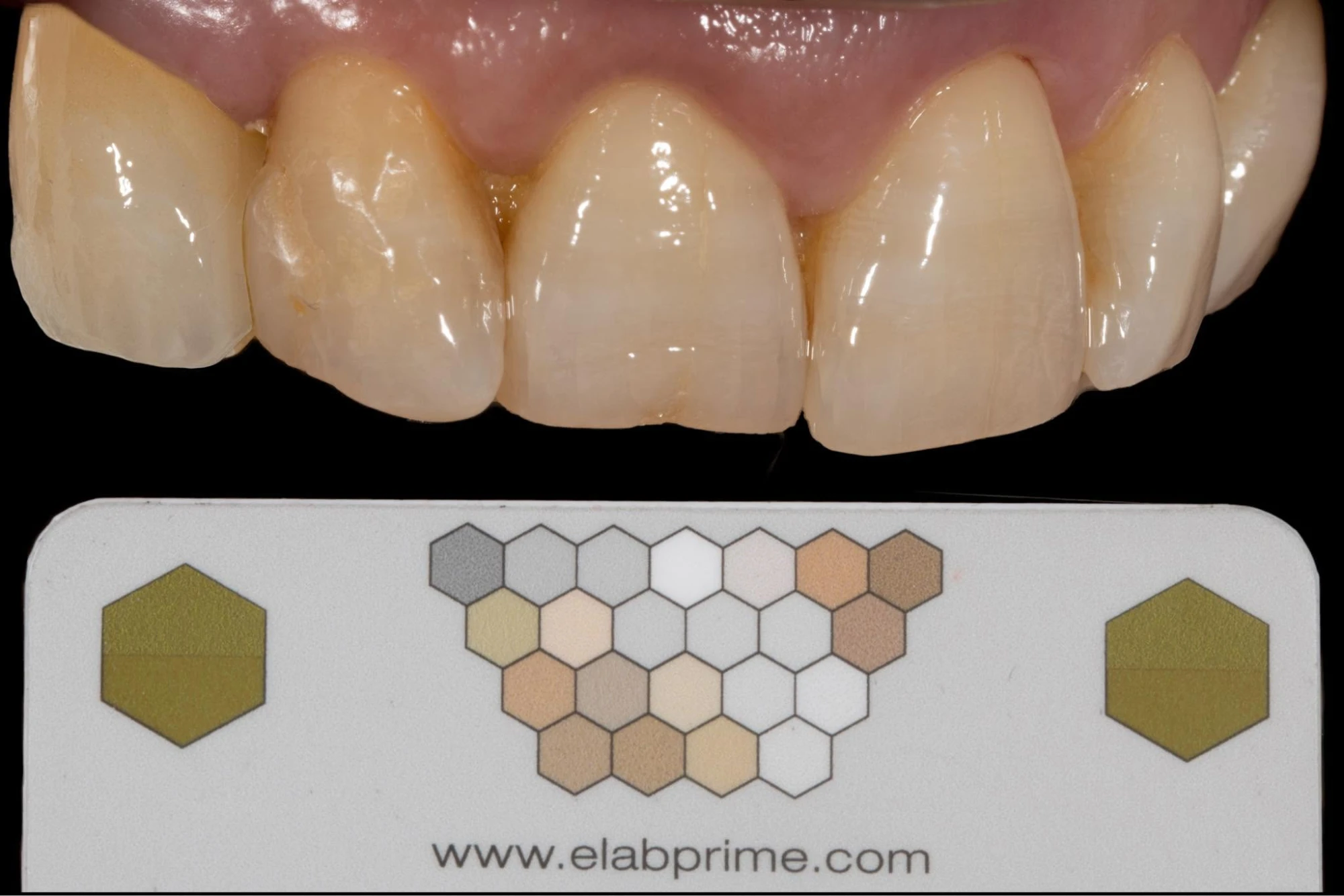 Anterior crowns beside a custom shade reference card