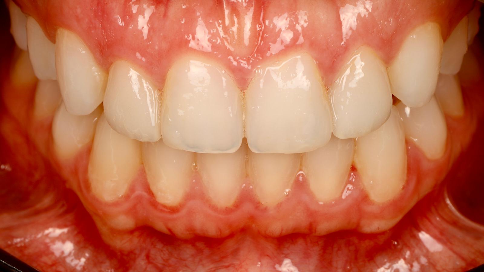 Seated anterior restorations, retracted final view